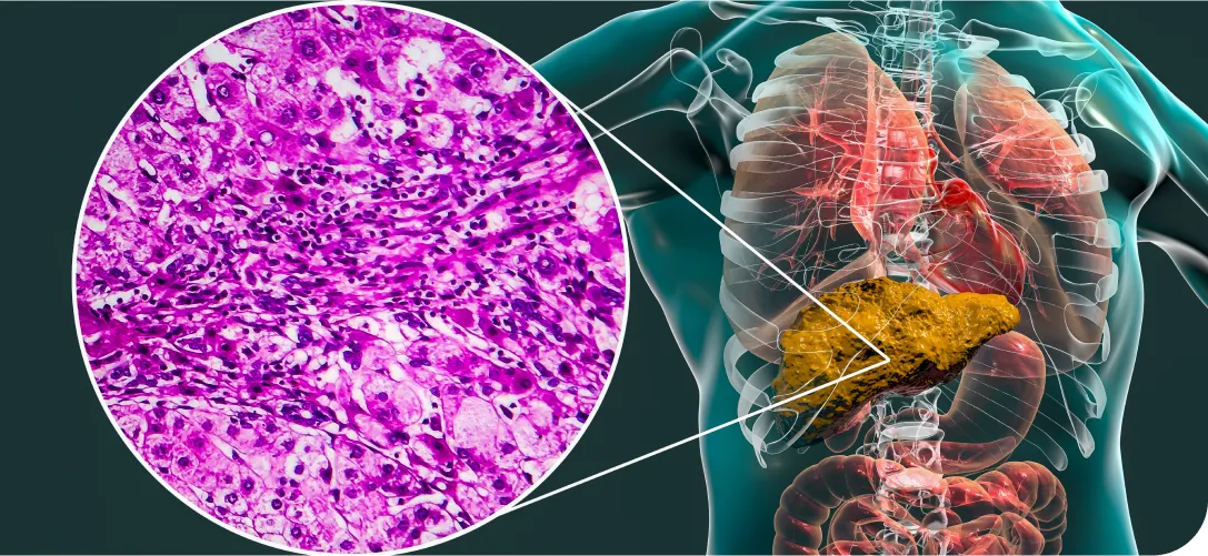 hepatocellular-carcinoma